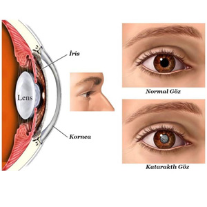 Katarakt ameliyatını ne zaman olmalıyım?