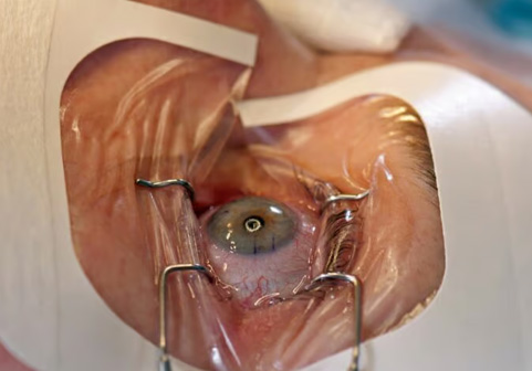 Lazerle Göz Ameliyatının (LASIK) Potansiyel Riskleri ve Bilimsel Bulgular