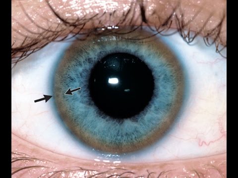 Göze bakılarak veya göz dibi incelenerek tespit edilebilen hastalıklar nelerdir?