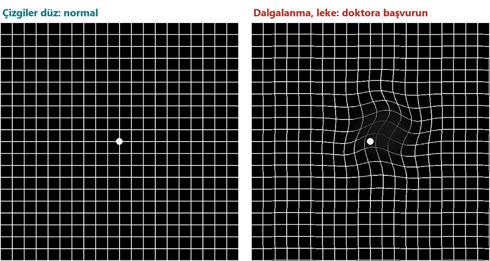 Solda düz çizgili normal Amsler ızgarası, sağda ortası dalgalı ve lekeli bozuk görünüm
